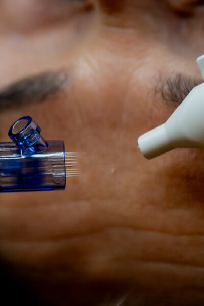 Microneedling # Behandelingen