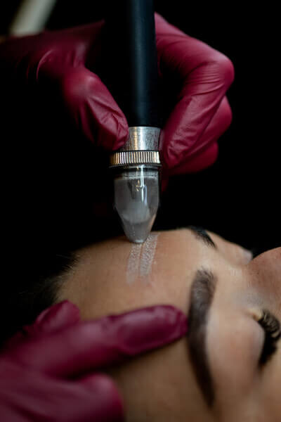 Microdermabrasion # Behandelingen